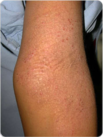 Photo of moderate atopic dermatitis