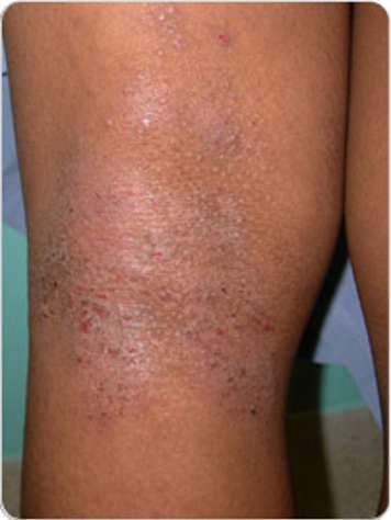 Photo of severe atopic dermatitis