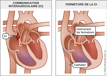 Un cœur avec une communication interauriculaire avant intervention et un cœur avec un instrument de fermeture et un cathéter