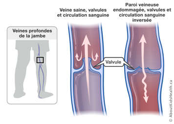 Circulation normale dans veine et valvules saines et circulation sanguine inversée dans veine et valvules endommagées