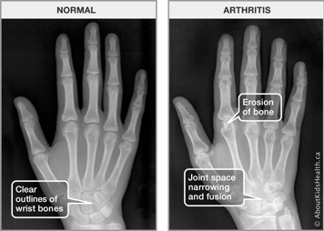 X-rays of normal hand with clear outlines of bones and of arthritic hand with bone erosion, joint space narrowing and fusion