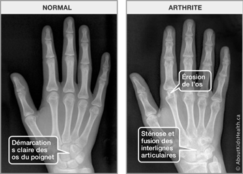 Radiographies d’une main normale et d’une main arthritique avec érosion, sténose et fusion des os et interlignes articulaires