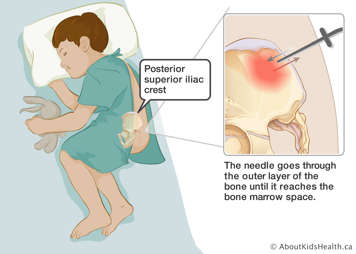 Needle inserted into posterior superior iliac crest until it reaches the bone marrow space