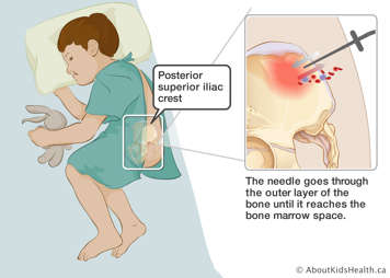 Needle going through the outer layer of the bone to reach the bone marrow space in the posterior superior iliac crest