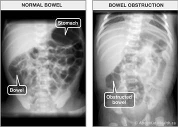 X-ray of normal bowel and x-ray of obstructed bowel
