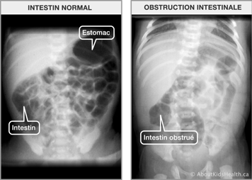 Rayon-x d’un intestin normal et rayon-x d’un intestin obstrué