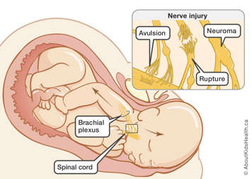 Brachial plexus injury during birth that can result in avulsion, rupture or neuroma