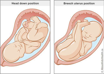 Baby in head down position in uterus compared to baby in breech position in uterus