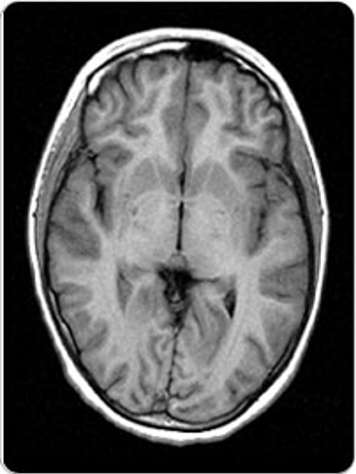 IRM neurologique d'une vue axiale