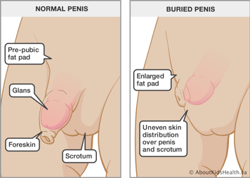 Normal penis and a buried penis with enlarged fat pad and uneven skin distribution over penis and scrotum