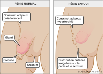 Pénis normal et pénis enfoui avec coussinet adipeux hypertrophié et distribution cutanée irrégulière sur le pénis et scrotum
