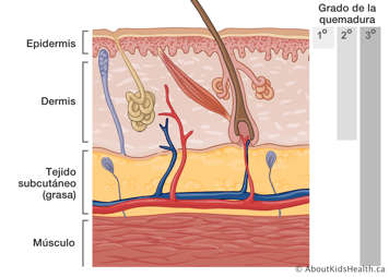 El corte transversal de la piel ilustrando los rados de lesiones por quemadura