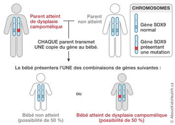 Distribution des chromosomes d’un parent atteint de dysplasie campomélique et d’un parent non atteint