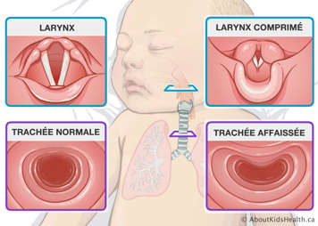 Un larynx normal et larynx comprimé et une trachée normale et trachée affaissée et où ils se trouvent dans un bébé