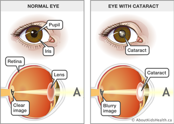 Normal eye seeing a clear image and eye with cataract seeing a blurry image