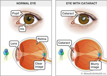 Pupil and iris of a normal eye seeing a clear image of balloons and eye with cataract over the pupil seeing a blurry image