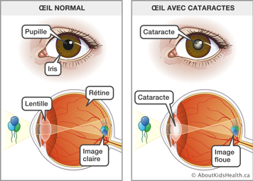 La pupille et iris d’un œil normal voyant une image claire des ballons et un œil avec cataractes voyant une image floue