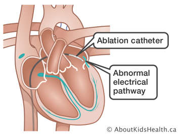 A heart with an ablation catheter inserted and an abnormal electrical pathway