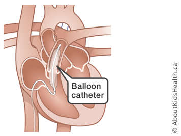 Illustration of a balloon catheter in the heart