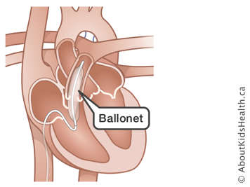 Illustration d’un ballonet inséré dans le cœur