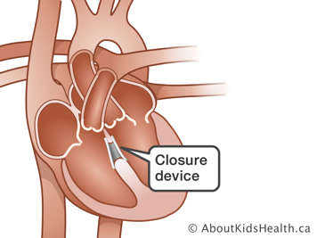 Illustration of heart with closure device
