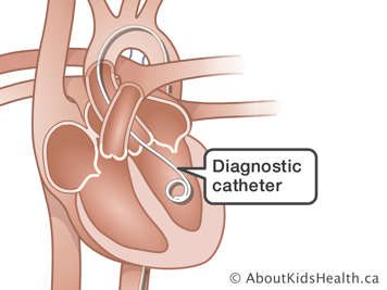 Illustration of a diagnostic catheter in the heart