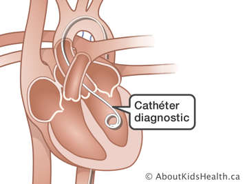 Illustration d’un cathéter diagnostic inséré dans le cœur