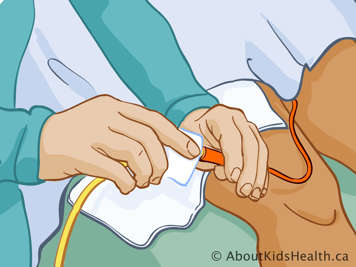 Cleaning connection site of catheter with alcohol swab