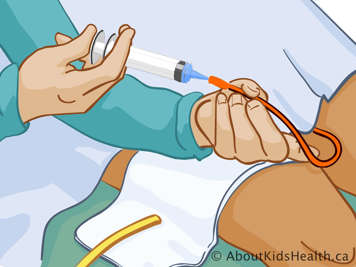 Inyección de solución salina en el catéter con una jeringa