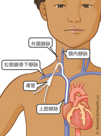 插入外頸靜脈、頸內靜脈、右側鎖骨下靜脈以及上腔靜脈的導管