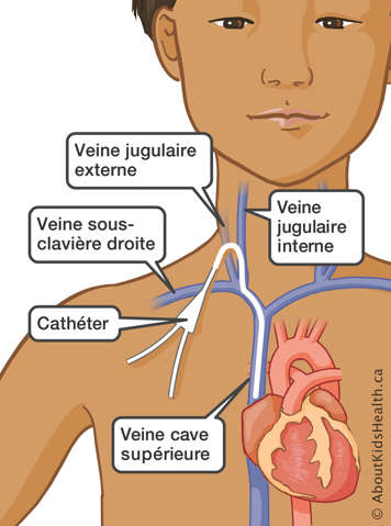 Un cathéter inséré dans la veine cave supérieure, les veines jugulaires externe et interne et la veine sous-clavière droite