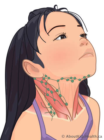 Medical illustration of lymph nodes in the side of a child's neck and along her jaw