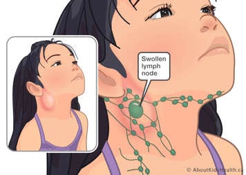 Medical illustration of swollen lymph node on side of child's neck, below their jaw