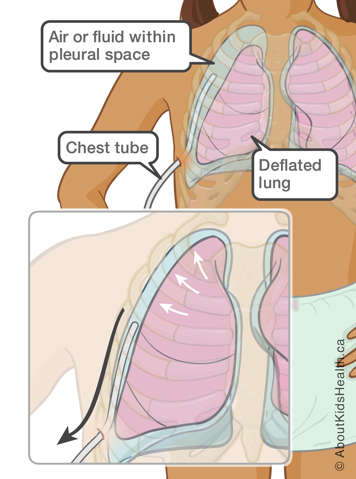 Chest tube inserted into the pleural space around a deflated lung