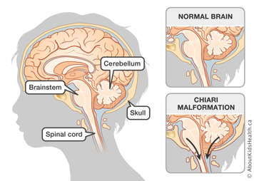 The cerebellum, skull, spinal cord and brainstem in a normal brain and in a brain with chiari malformation