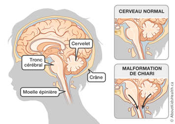 Cervelet, crâne, tronc cérébral et moelle épinière dans un cerveau normal et dans un cerveau avec malformation de Chiari