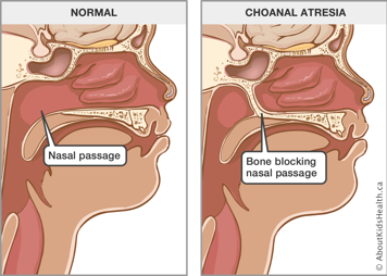A normal nasal passage and a nasal passage with choanal atresia