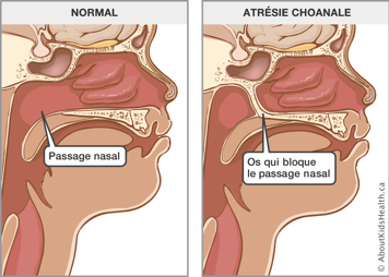 Un passage nasal normal et un passage nasal avec l’atrésie choanale