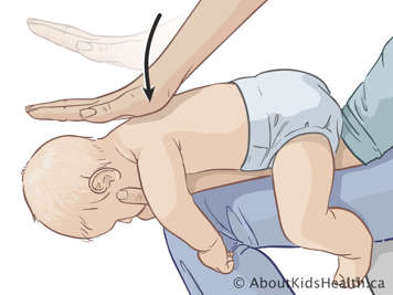 Aplicando golpes en la espalda a un bebé colocado boca abajo sobre la rodilla de una persona