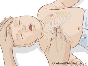 Exerçant des compressions thoraciques sur un nourrisson couché sur son dos