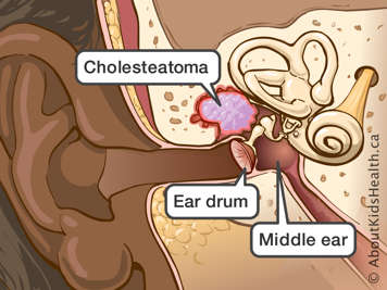 Identification of the cholesteatoma, middle ear and ear drum