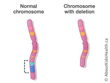 A normal chromosome next to a chromosome with deletion