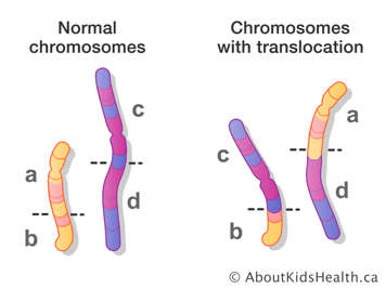 Normal chromosomes and chromosomes with translocation