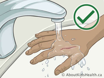 Arrosant une plaie sur la main &agrave; l&rsquo;aide de l&rsquo;eau courante