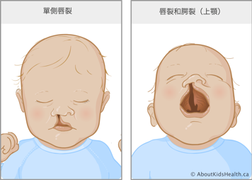 唇裂至鼻底的嬰兒，以及唇齶裂的嬰兒