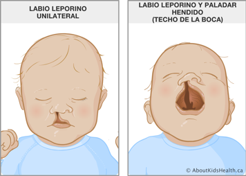 Bebé con fisura en el labio hasta el interior de la nariz y bebé con la boca abierta y la fisura en el labio y en el paladar