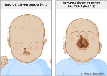Un bébé avec une fente de la lèvre jusqu’au nez et un bébé avec bouche ouverte, montrant une fente dans le palais et la lèvre