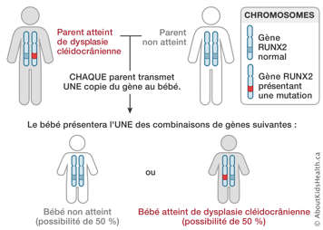 Distribution des chromosomes d’un parent atteint de dysplasia cléidocrânienne et d’un parent non atteint