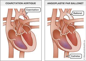 Un cœur avec une coarctation aortique à côté d'un cœur avec un ballonnet et un cathéter insérés