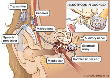 The parts of a cochlear implant and where they are found in and outside of the ear
